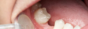 Missing tooth space in mouth close-up. Doctor dentist look into open mouth