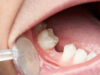 How Does Extraction Prioritize Oral Health?