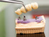 Various Benefits of Prosthetic Dentistry