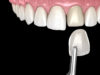 Dramatic Smile Improvement With Veneers
