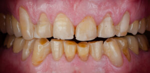 The chipped and worn teeth