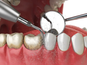 Professional teeth cleaning. Ultrasonic teeth cleaning machine delete dental calculus from human teeth. 3d illustration