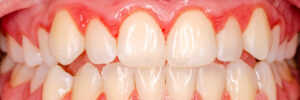teeth with gingivitis