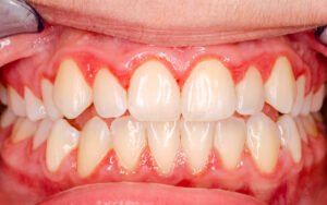 teeth with gingivitis