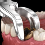 When Can Your Smile Benefit From Extraction?