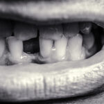 Instances Warranting Dental Extraction