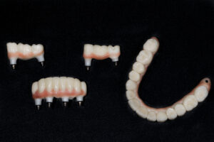 Dental crown and prosthesis for total gluing and install the patient after surgery, implant