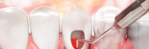 Root canal treatment process. 3d illustration