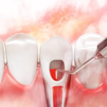 How Decay Damages Your Teeth Roots