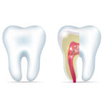 How Your Smile Benefits From Root Canal Therapy