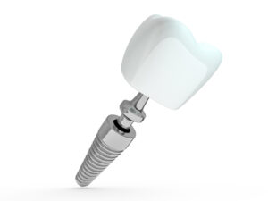 Dental implant dentist, tooth layout, plastics, man, teeth treatment 3D rendering