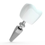 Major Functions Of Dental Implant Posts