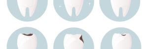 Set of teeth damaged by decay, cracks and chips. Tooth and ename