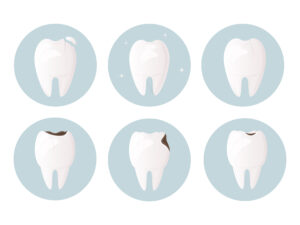 Set of teeth damaged by decay, cracks and chips. Tooth and ename