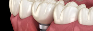 Peri-implantitis with visible gum recession. Medically accurate 3D illustration of dental implants concept