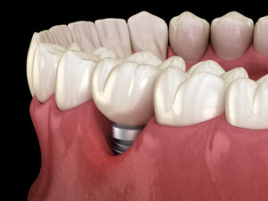 Peri-implantitis with visible gum recession. Medically accurate 3D illustration of dental implants concept