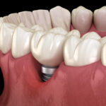 Replace Missing Teeth With Implants