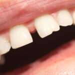 A Damaged Tooth Is A Dental Emergency