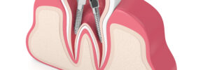 conroe root canal therapy