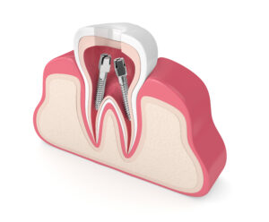 conroe root canal therapy