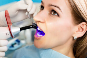 conroe dental bonding